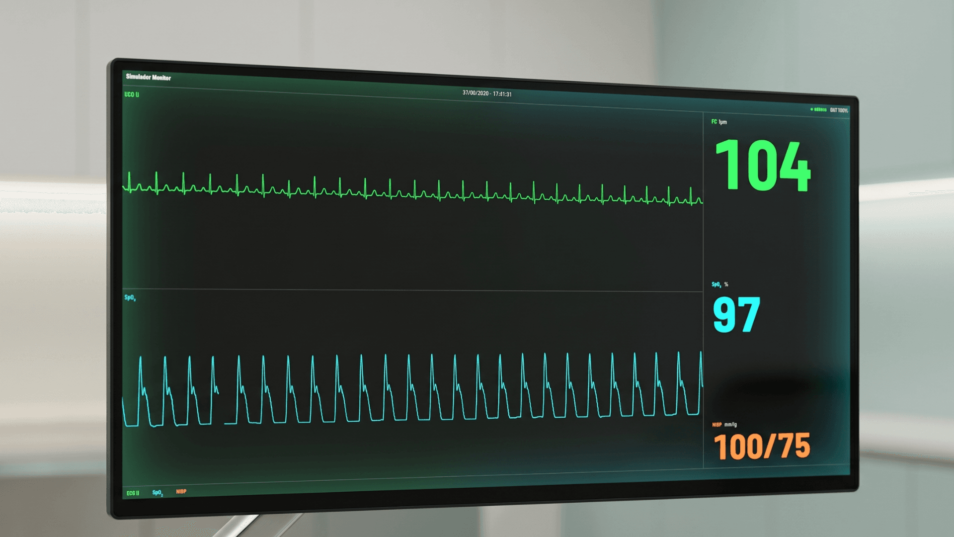 Detalle del monitor: traza de ECG en verde, pletismografía de pulso en cian y lecturas de frecuencia cardíaca, SpO₂ y presión arterial no invasiva.